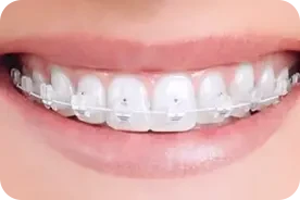брекеты